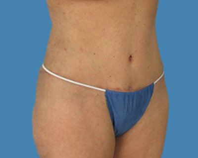 After Image: LipoTuck, Tummy Tuck - front
