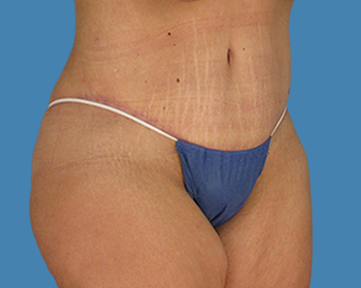 After Image:  - front