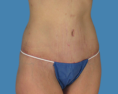 After Image:  - front