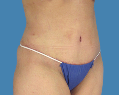 After Image: LipoTuck, Tummy Tuck - front
