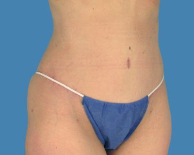 After Image: LipoTuck, Tummy Tuck - front
