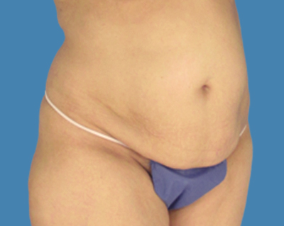 Before Image: LipoTuck, Tummy Tuck - front