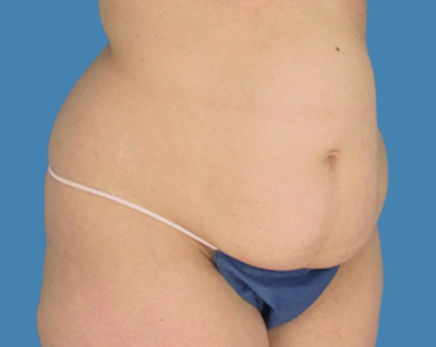 Before Image: LipoTuck, Tummy Tuck - front