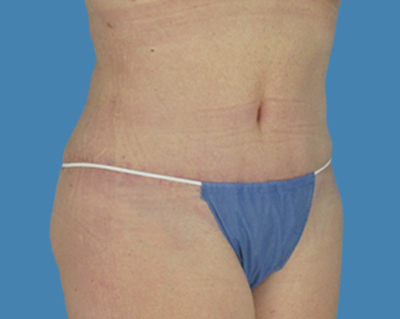 After Image: LipoTuck, Tummy Tuck - front