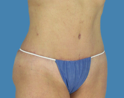 After Image:  - front