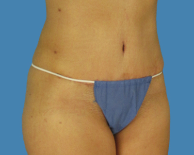 After Image:  - front