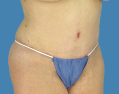 After Image: LipoTuck, Tummy Tuck, Plus-Size Tummy Tuck - front