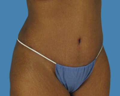After Image: LipoTuck, Tummy Tuck, Plus-Size Tummy Tuck - front