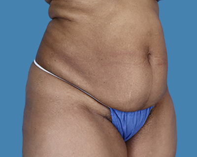 Before Image: LipoTuck - front