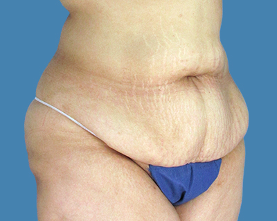 Before Image: LipoTuck - front