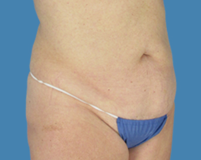 Before Image: LipoTuck, Tummy Tuck - front