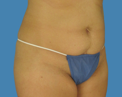 Before Image:  - front