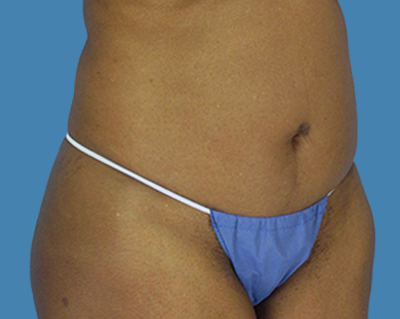 Before Image:  - front
