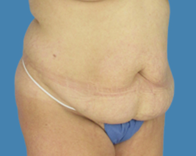 Before Image: LipoTuck, Tummy Tuck, Plus-Size Tummy Tuck - front