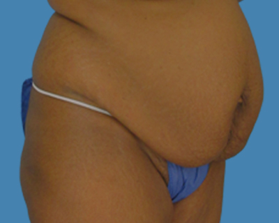 Before Image: LipoTuck, Tummy Tuck, Plus-Size Tummy Tuck - front