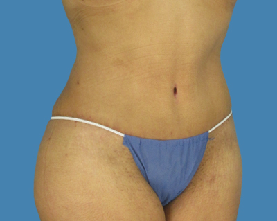 After Image: LipoTuck, Tummy Tuck, Plus-Size Tummy Tuck - front