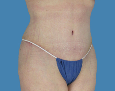 After Image: LipoTuck, Tummy Tuck - front