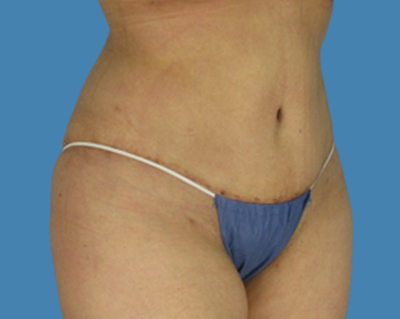 After Image: LipoTuck, Tummy Tuck, Plus-Size Tummy Tuck - front