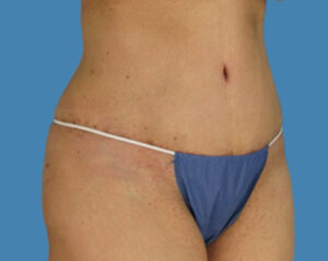 After Image: LipoTuck, Tummy Tuck, Plus-Size Tummy Tuck