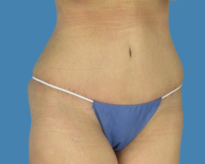After Image: LipoTuck, Tummy Tuck - front