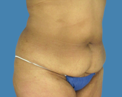 Before Image: LipoTuck, Tummy Tuck, Plus-Size Tummy Tuck - front