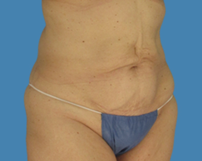 Before Image: LipoTuck, Tummy Tuck - front