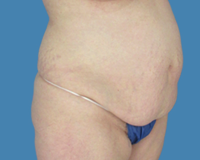 Before Image: LipoTuck, Tummy Tuck - front