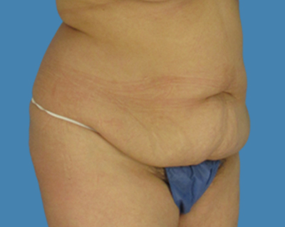 Before Image: LipoTuck, Tummy Tuck, Plus-Size Tummy Tuck - front