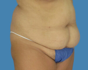 Before Image: LipoTuck, Tummy Tuck, Plus-Size Tummy Tuck