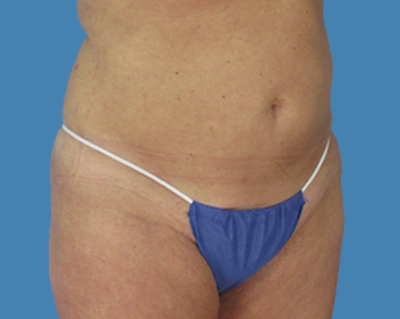 Before Image: LipoTuck, Tummy Tuck - front