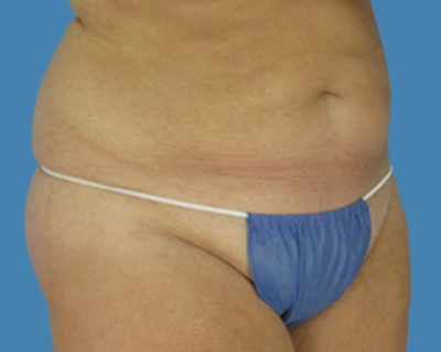 Before Image: LipoTuck, Tummy Tuck, Plus-Size Tummy Tuck - front