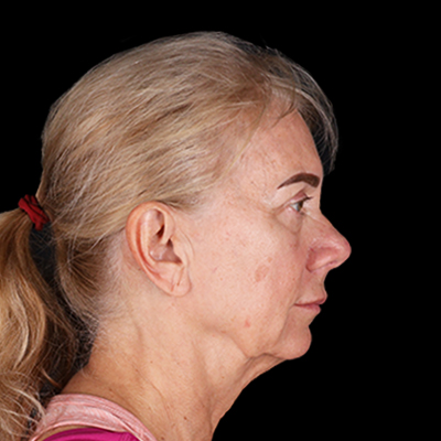 After Image: Rhinoplasty - right-side