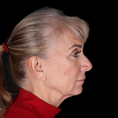 Before Image: Rhinoplasty - right-side