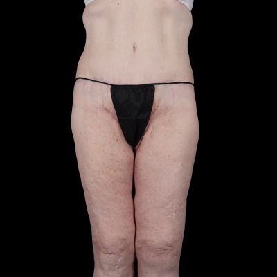 After Image: Thigh Lift - front