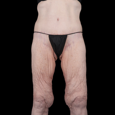 Before Image: Thigh Lift - front