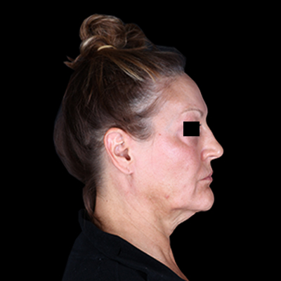 Before Image: Neck Lift - right-side