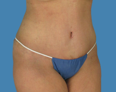 After Image: LipoTuck, Tummy Tuck - front