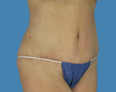 After Image: LipoTuck, Tummy Tuck, Plus-Size Tummy Tuck - front