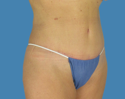 After Image: LipoTuck, Tummy Tuck - front