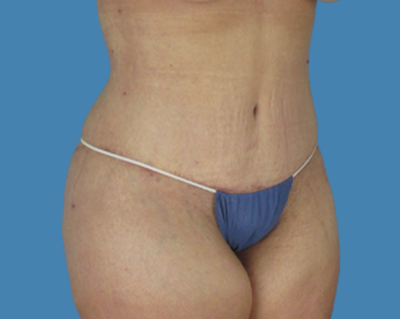 After Image: LipoTuck, Tummy Tuck - front
