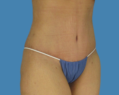 After Image: LipoTuck, Tummy Tuck - front