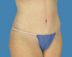 After Image: LipoTuck, Tummy Tuck