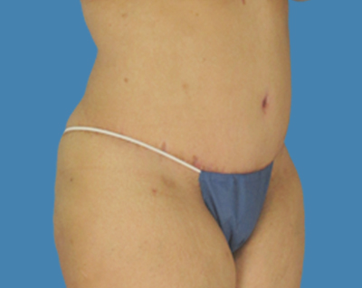After Image: LipoTuck, Tummy Tuck, Plus-Size Tummy Tuck - front