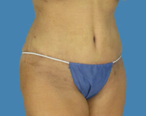 After Image: LipoTuck, Tummy Tuck, Plus-Size Tummy Tuck