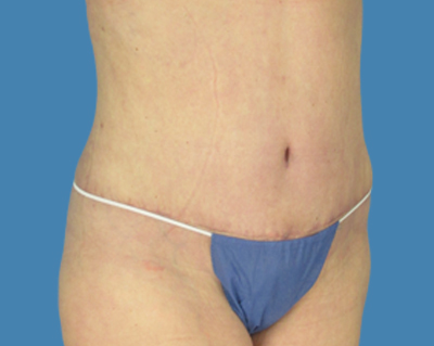 After Image: LipoTuck, Tummy Tuck, Plus-Size Tummy Tuck - front