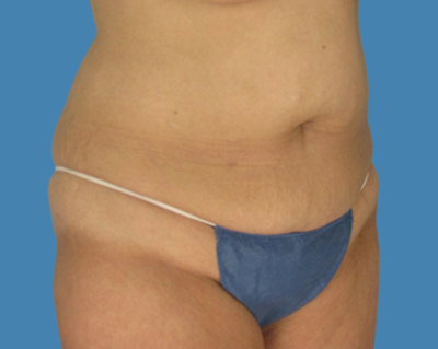 Before Image: LipoTuck, Tummy Tuck - front