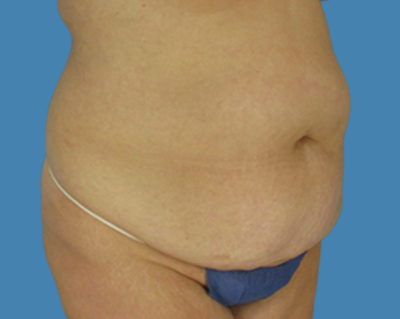Before Image: LipoTuck, Tummy Tuck, Plus-Size Tummy Tuck - front