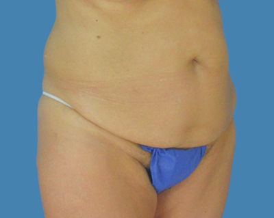 Before Image: LipoTuck, Tummy Tuck - front