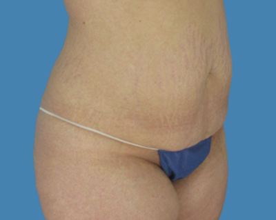 Before Image: LipoTuck, Tummy Tuck - front