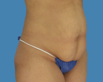 Before Image: LipoTuck, Tummy Tuck - front